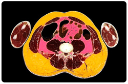 Corte abdominal, donde se observa la grasa visceral
